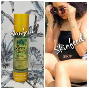 Zero Clear Stretchmark Oil. For Stubborn Marks & Scars X1. Works Fast 💯👌